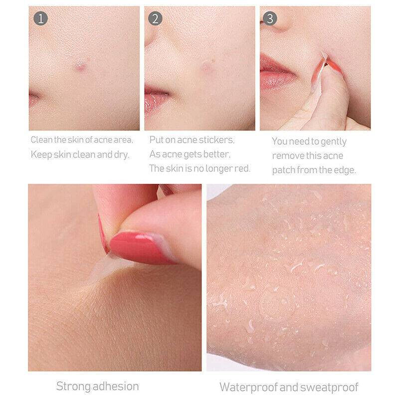 36pcs Acne Pimple Patch Acne Removal Stickers Blemish Treatment Face Skin.l8