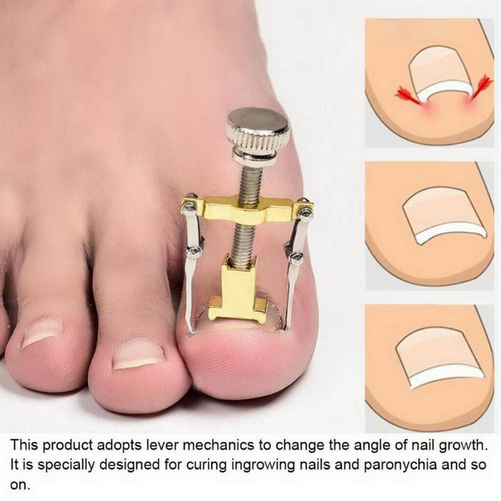 2pcs Ingrown Toe Nail Correction Fixer Straightener Clippers Tools