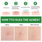 24pcs Acne Stickers Acne Patch Transparent Invisible Remover