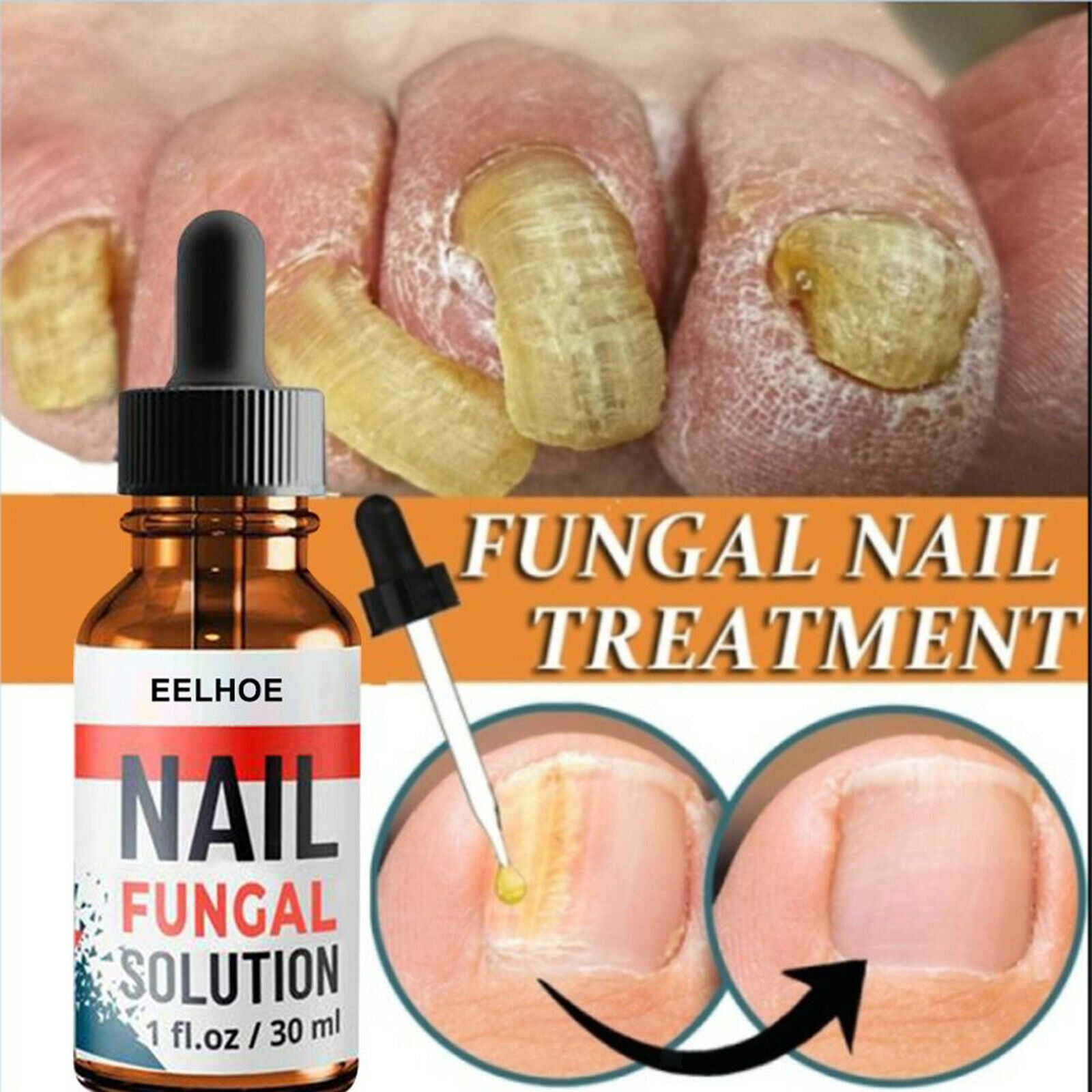 2x 1.02OZ Fungal Nail Treatment Repair Damaged Brittle Nail Paronychia