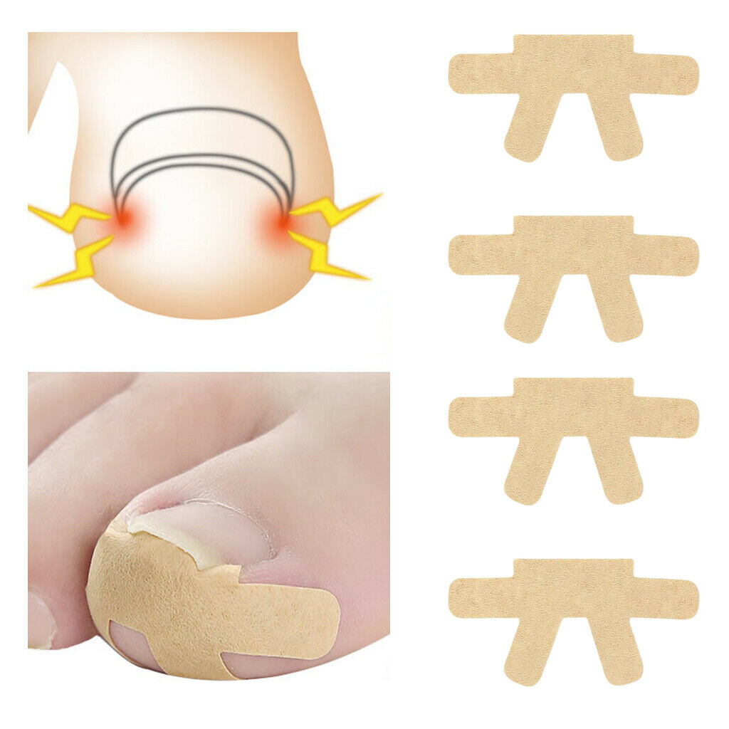4pcs Elastic Ingrown Toenail Corrector Strips Treatment Toenail Patch Brace
