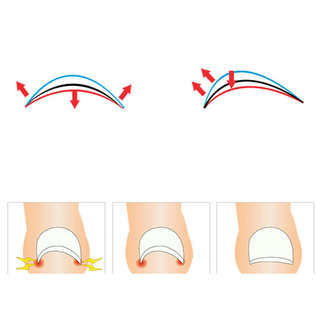 Plastic Ingrown Toenail Straightening Clips Nail Correction Stickers Clear