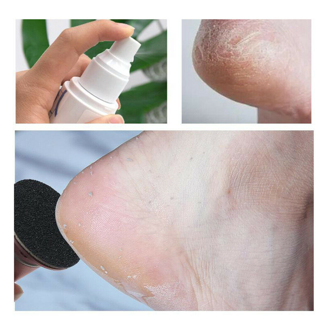 Eleven Ever Callo Foot Softener Soften Dry, Dead, Hard Skin
