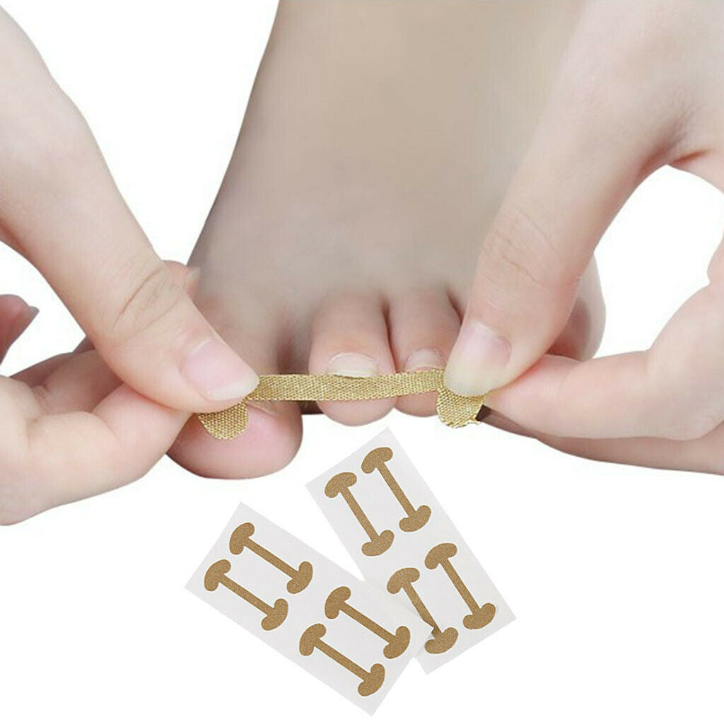 20 Pcs Ingrown Toe Nail Correction Stickers Fingernail Toes  Care