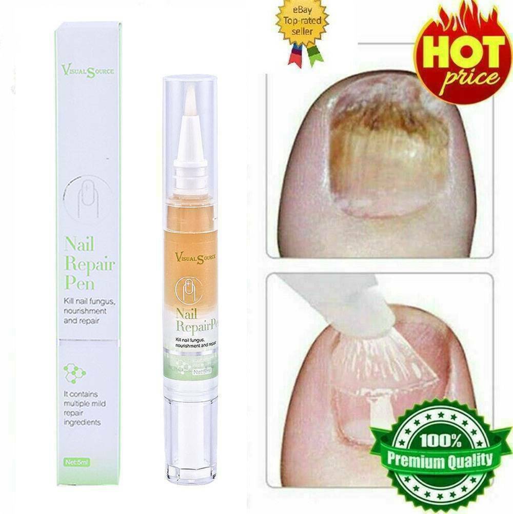 Fungal Nail Treatment Toe Fungus Removal Anti Infection Onychomycosis Liquid Pen