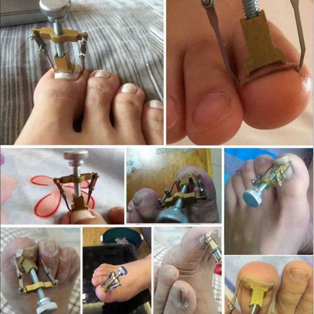 3pcs Ingrown Toe Nail Fixer Pedicure Toe Nail Correction Lifter Tool Set