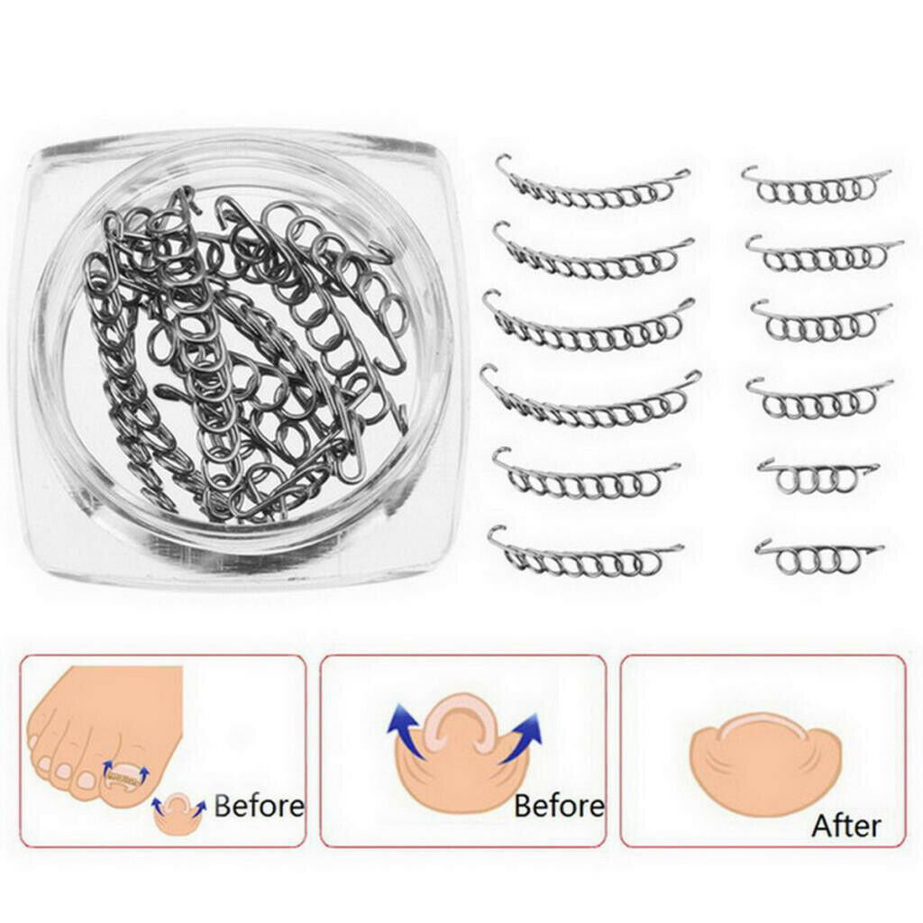 Bunion Toenails Corrector Wire Fixer Wire Recover Care Paronychia Patch Foot