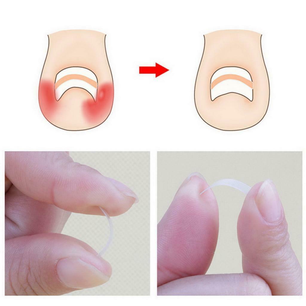 10-Packs Ingrown Toenail Correction Elastic Patches for Both Professional Use