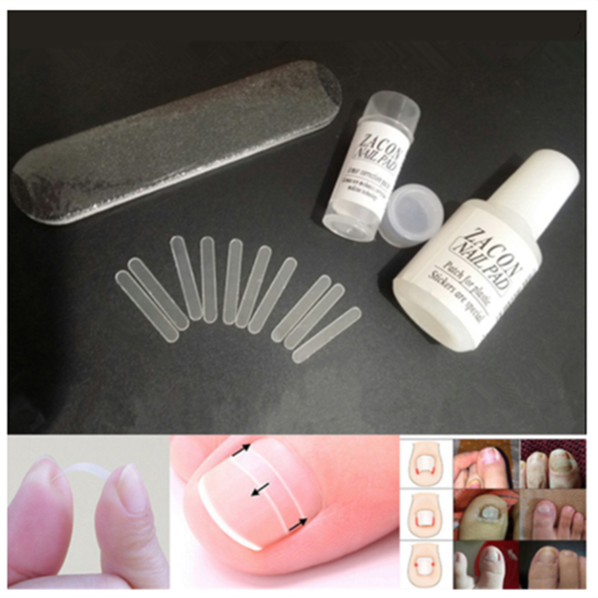 20pcs Ingrown Toenail Straightening Clip Curved Brace Treatment Tool With Glue