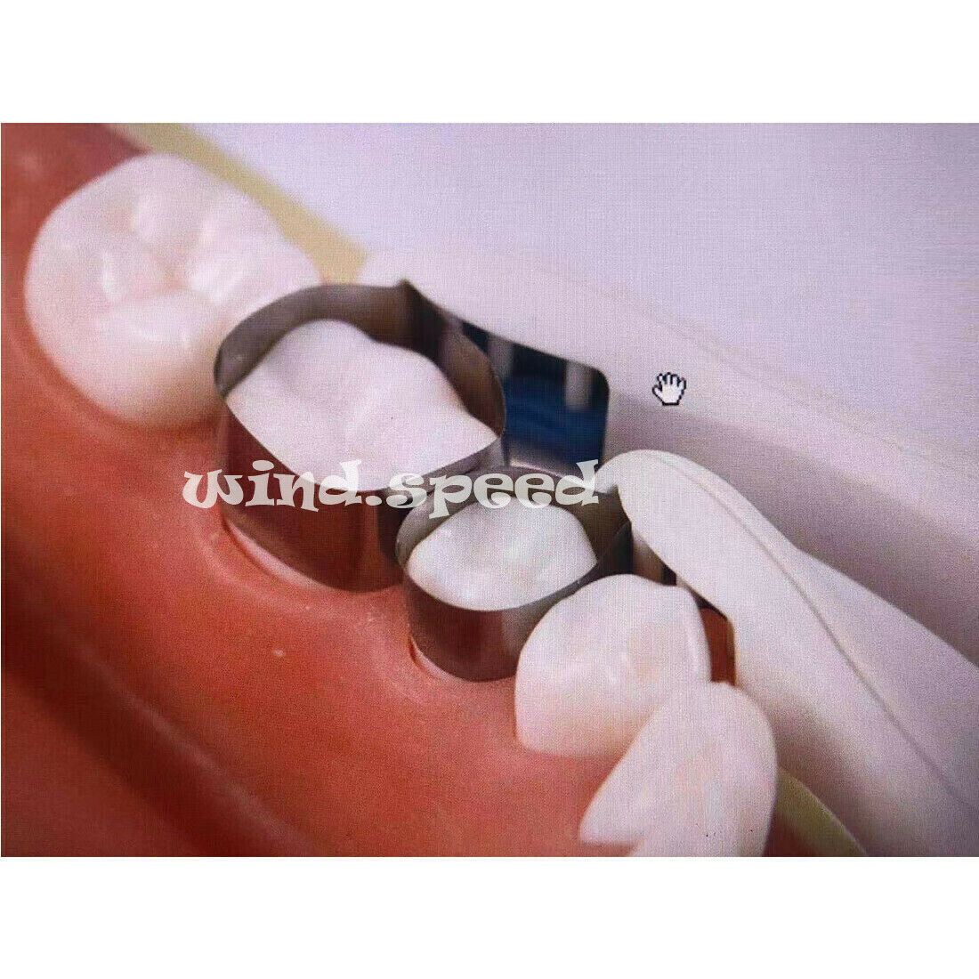 100pcs Dental PRO Matrix Bands Adjust Hold Single Use Curved Bands 6mm For Molar