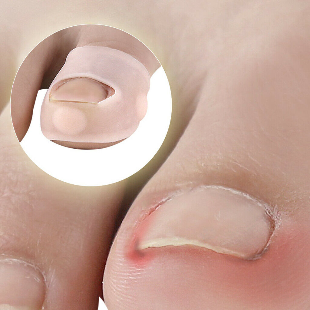 5 Pairs Silicone Ingrown Toenail Corrector Pedicure Tools for Men Women