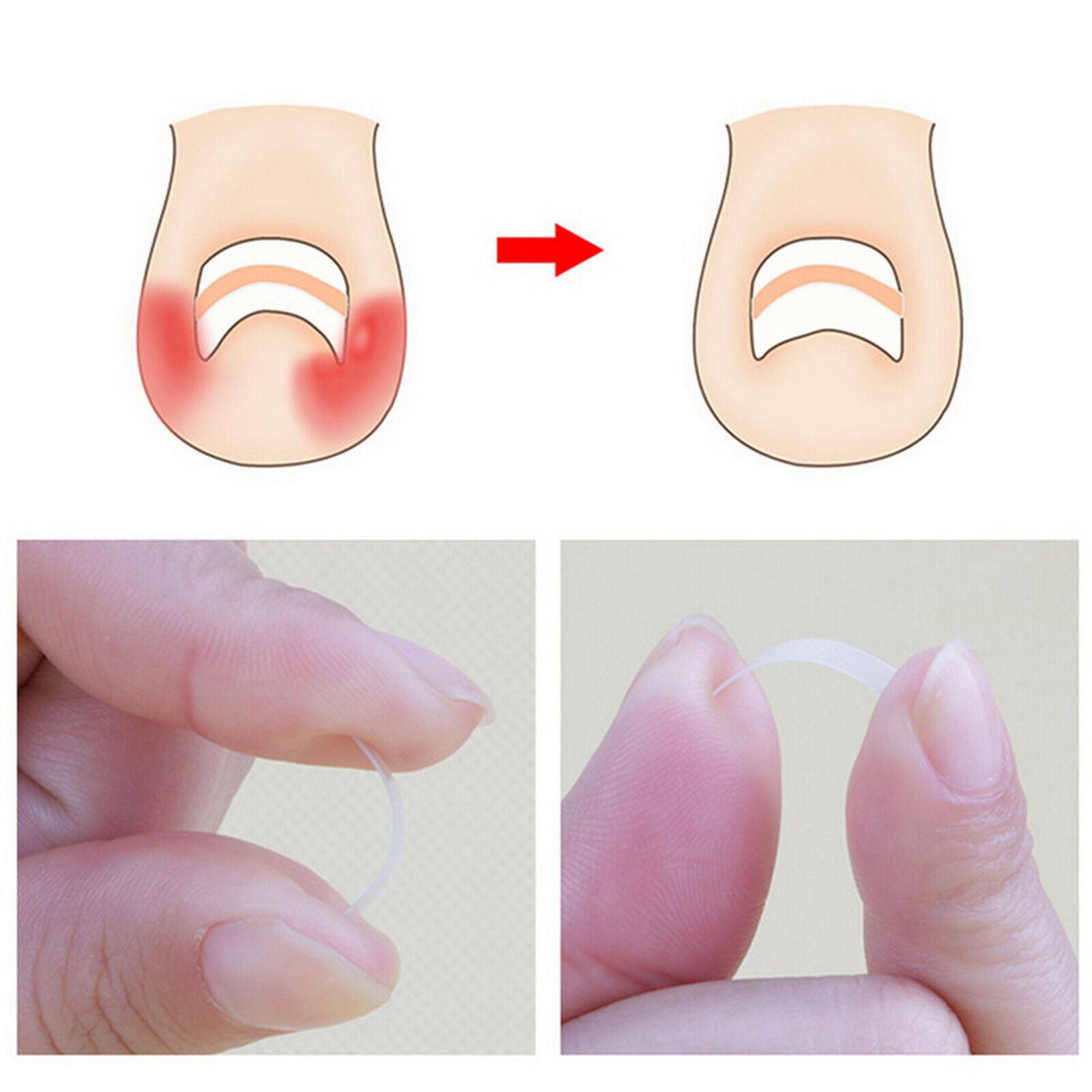 Ingrown Toenail Correction Tool Ingrown Toe Nail Pedicure Patch Straightening