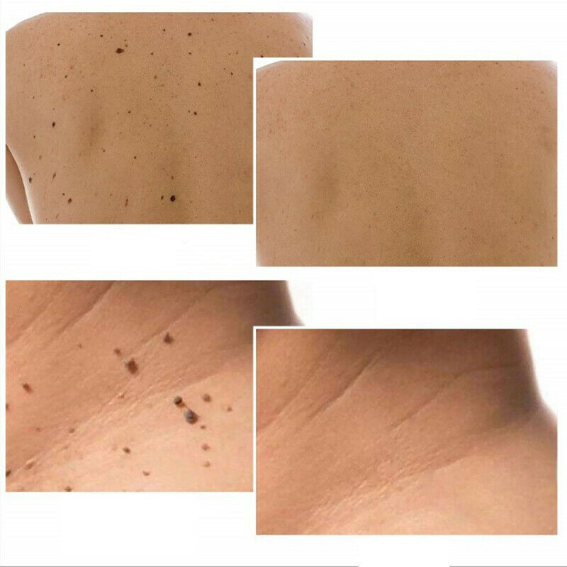 Skin Tag Remover Patch Ance Pimple Patch Anti-infection Quick Absorb Face.l8
