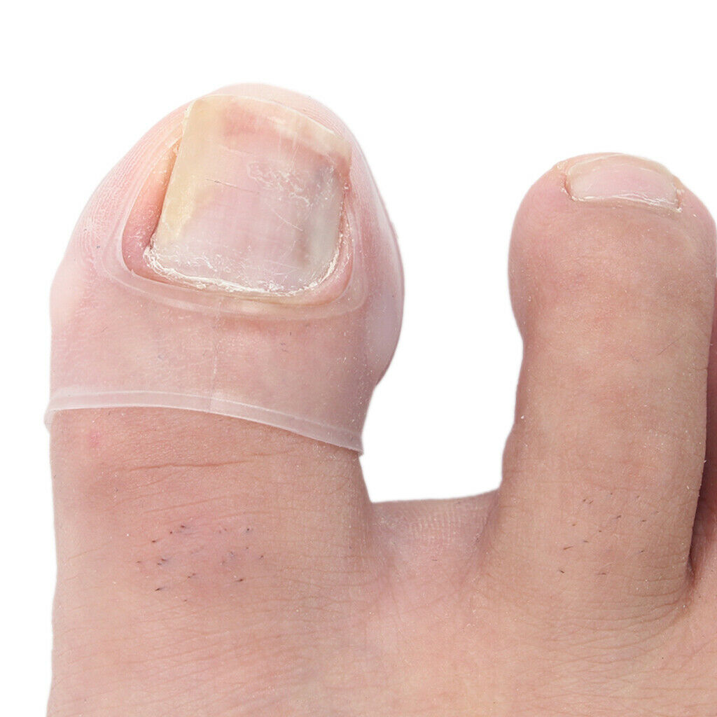 2Pcs Toe Nail Ingrown Correction Foot Care  Silicone Corrector Sleeves