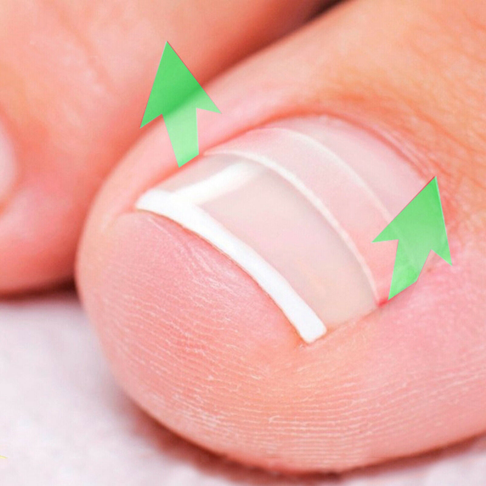 Professional Ingrown Toenail Corrections Kit Toenail Treatment Nail Glue Toenail