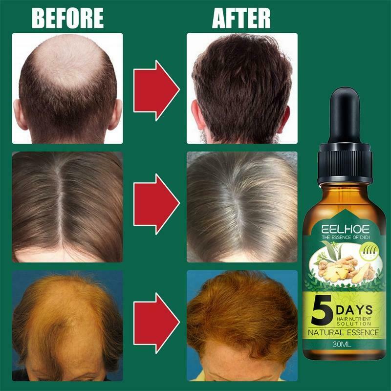30ml Unisex Natural Ginger Extract Hair Growth Spray Care Essence Nourishing