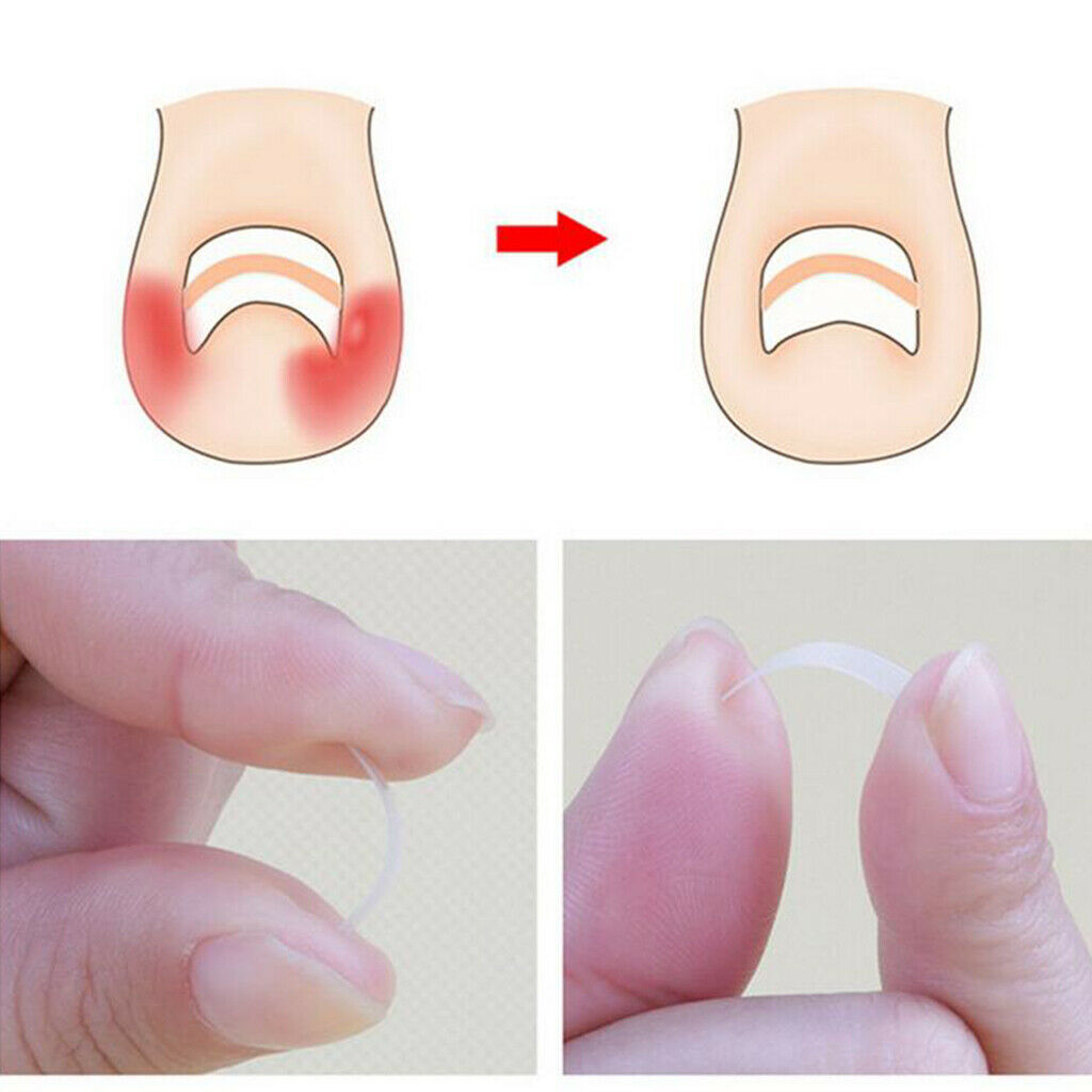Plastic Ingrown Toenail Straightening Clips Nail Correction Stickers Clear
