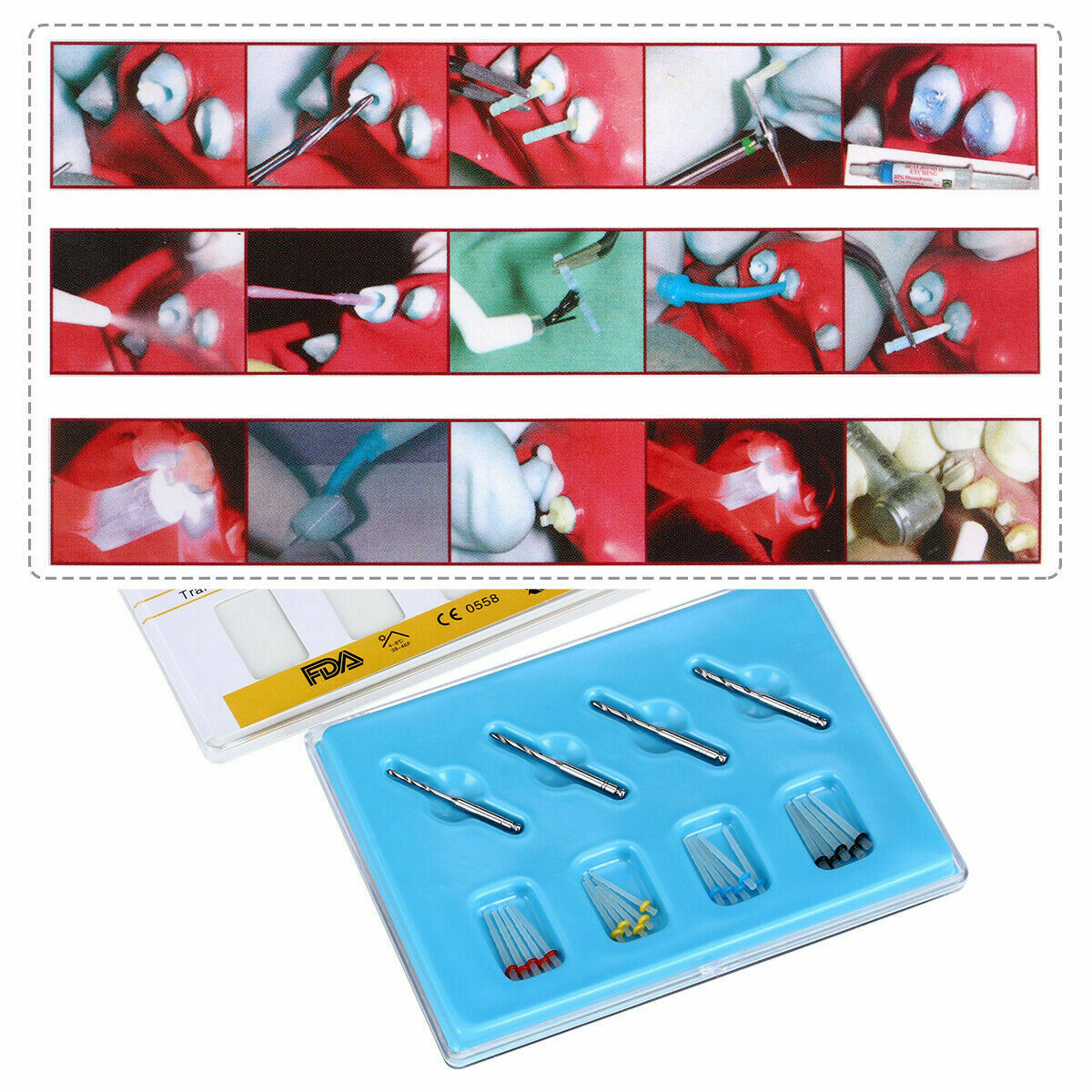 20 Pqts Dental AAA Tornillo de Resina de Poste de Fibra Alta Intensidad Hilo V