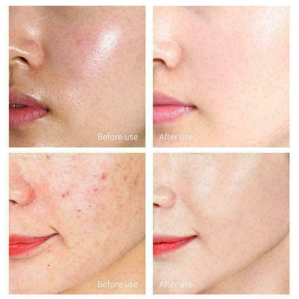 Purifying Acne Body Spray Salicylic acid acne spray 6T5R C6Q3 HOT NEW