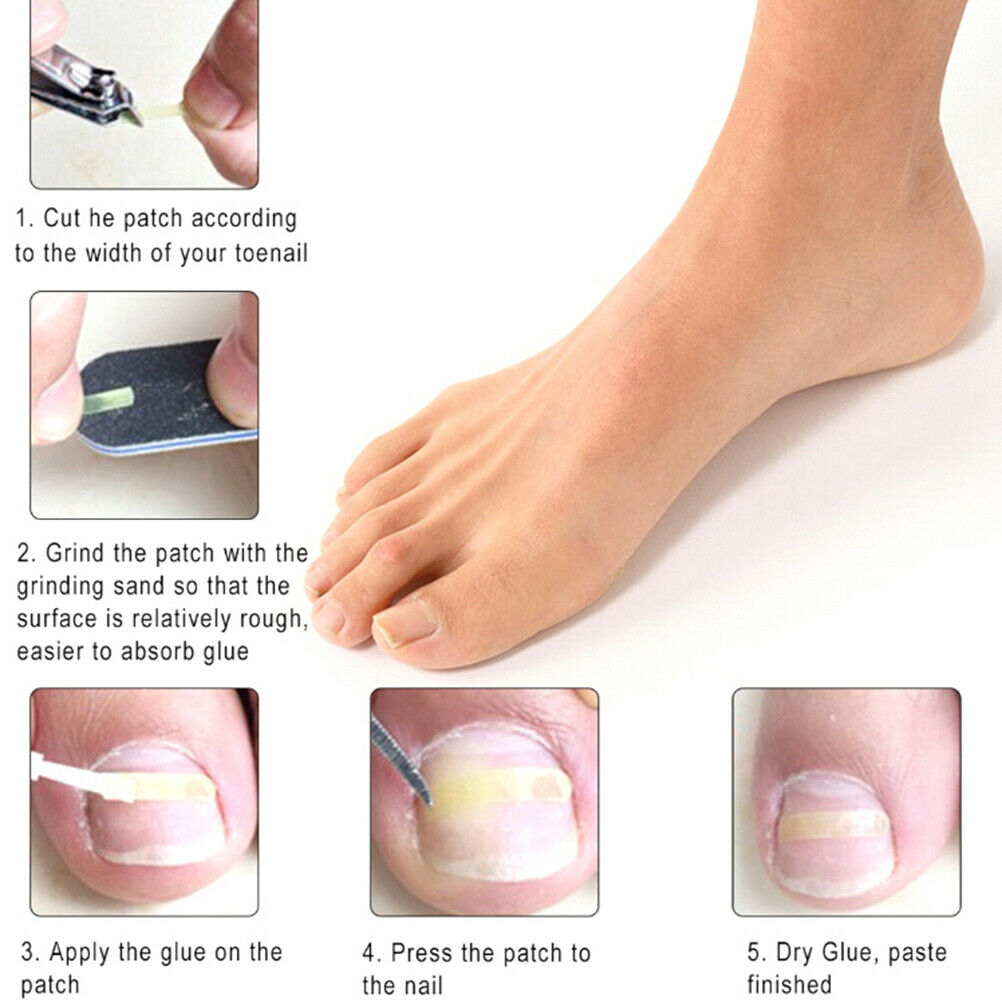Ingrown Toe Nail Correction Kit Toenail Treatment Nail Pusher Recover Foot C BU