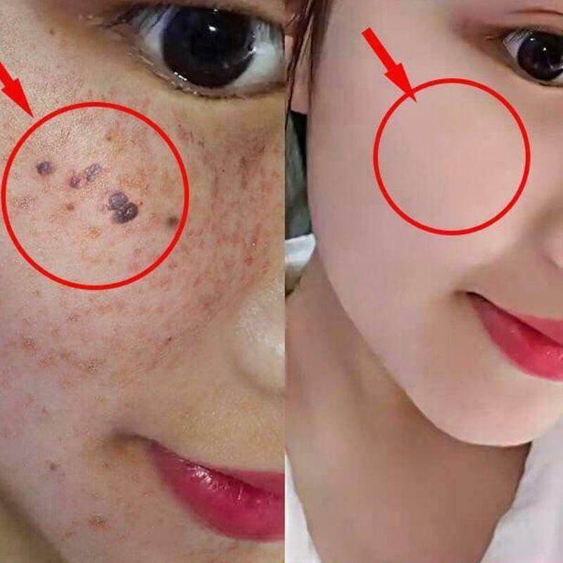 20ml Dark Spot Mole Repair Rose Essential Oil Skin Tag Freckle Painless Removal