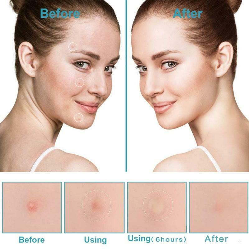 3pcs 108 Dots Acne Patch Pimple Patches Blemish Protective Cover Absorbing Spot