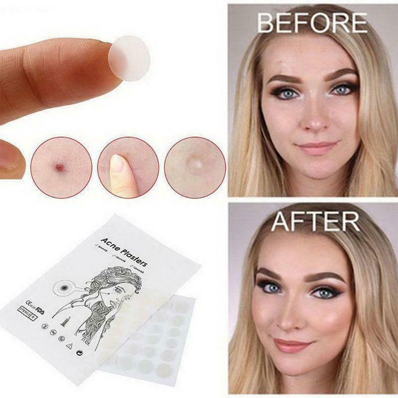 acne Pimple Patch, Hydrocolloid Acne Healing Patches, Invisible Absorbing Cover