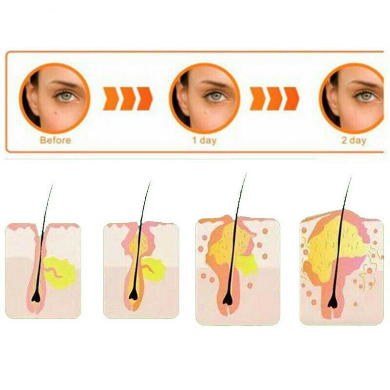 36Pcs Skin Tag & Acne Patch Hydrocolloid Acne and Skin Tag Remover Patch.l8