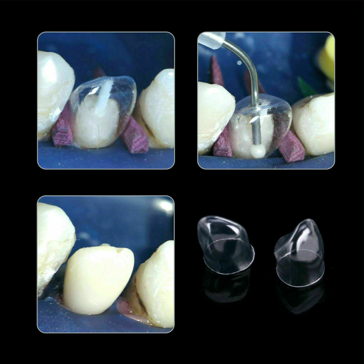 Dental 64 pcs Anterior Transparent Crowns for incisors / canines № 1.910 CA Site