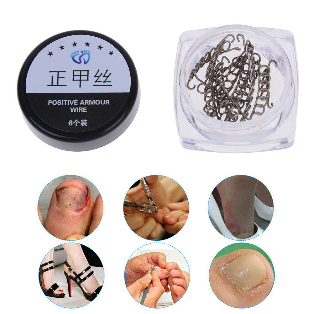 12pcs toenail correction tool ingrown wire fixer toe nail recover foot  TwY1