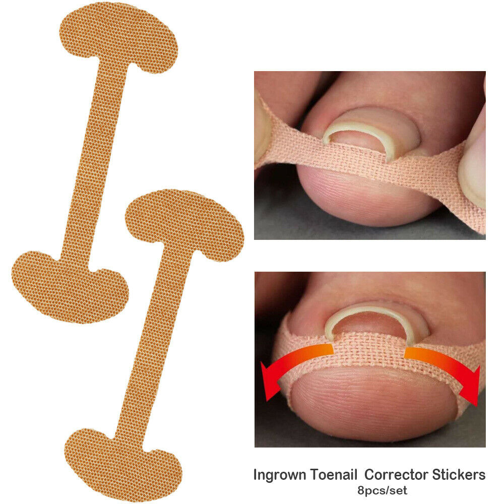 Paronychia Treatment  Ingrown Toenail Toe nail repair Foot Corrector Stickers