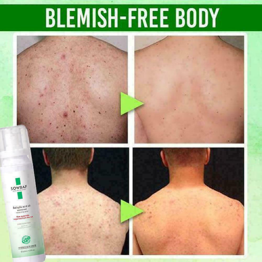 Purifying Acne Body Spray Salicylic acid acne spray 6T5R C6Q3 HOT NEW