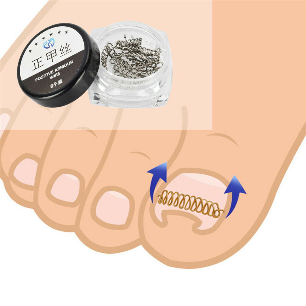 Nail Care Ingrown Toenail Correction Wire Fixer Toe Nail Corrector Pedicure