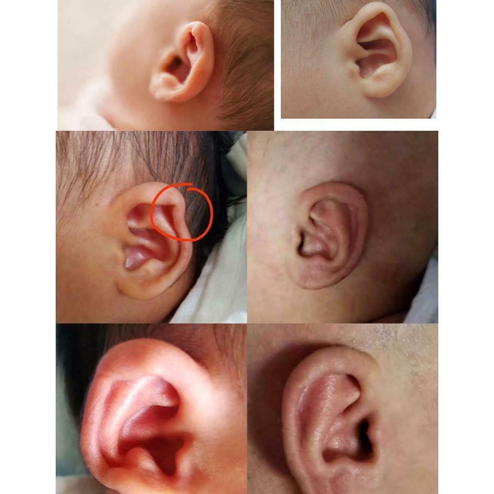 Infant Silicone Auricle Correction Pad Auricle Plaster Protruding Ear Plaster