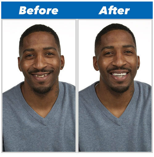 Tooth Replacement Perfect Smile Reusable Removable Installation Instant - New