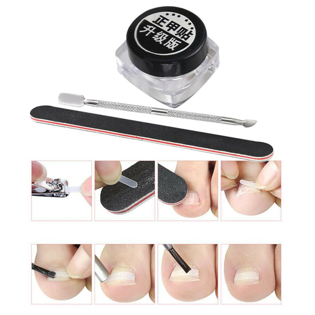 Ingrown Toenail Corrector Stickers Tape w/Pusher Nail File Set Pain Ease