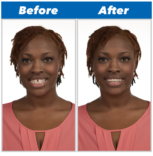 Tooth Replacement Perfect Smile Reusable Removable Installation Instant - New