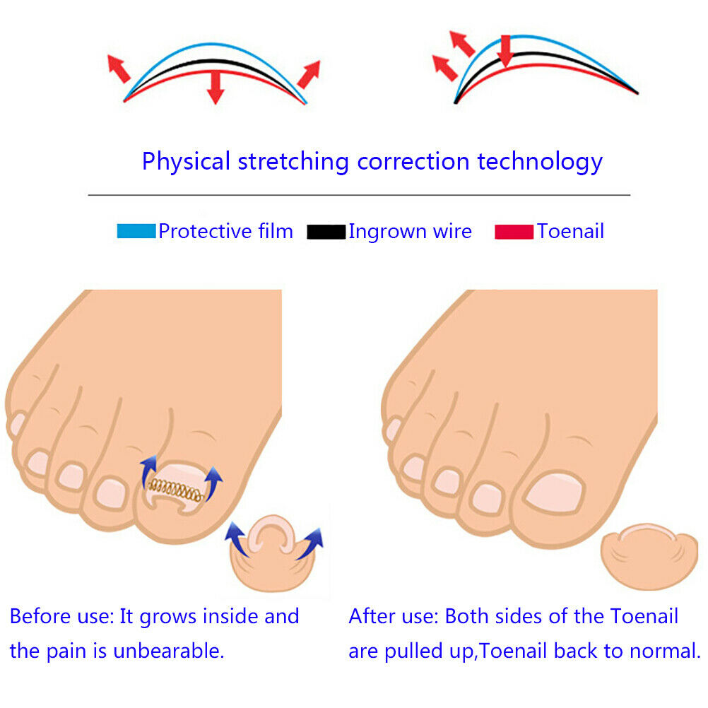 12pcs toenail correction tool ingrown wire fixer toe nail recover foot  TwY1