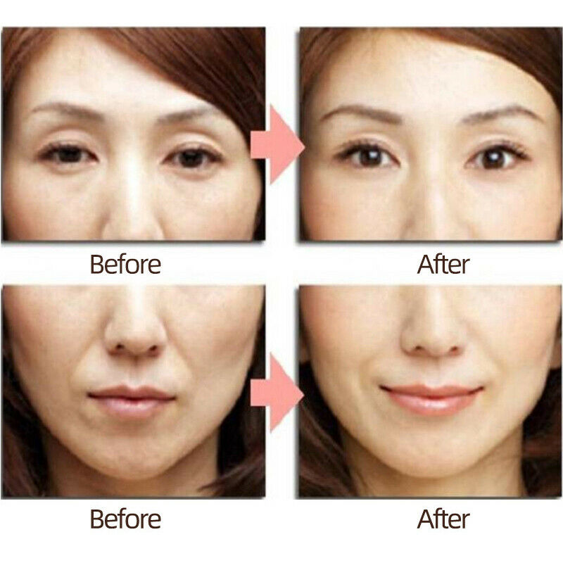 Invisible Bands to Remove Statute Lines Eye Bags Wrinkles Crow's feet Hairpl XC