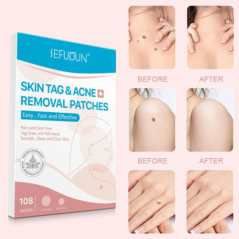 108pcs Skin Tag Remover Patch Hydrocolloid Acne Pimples Moles Zits War.l8