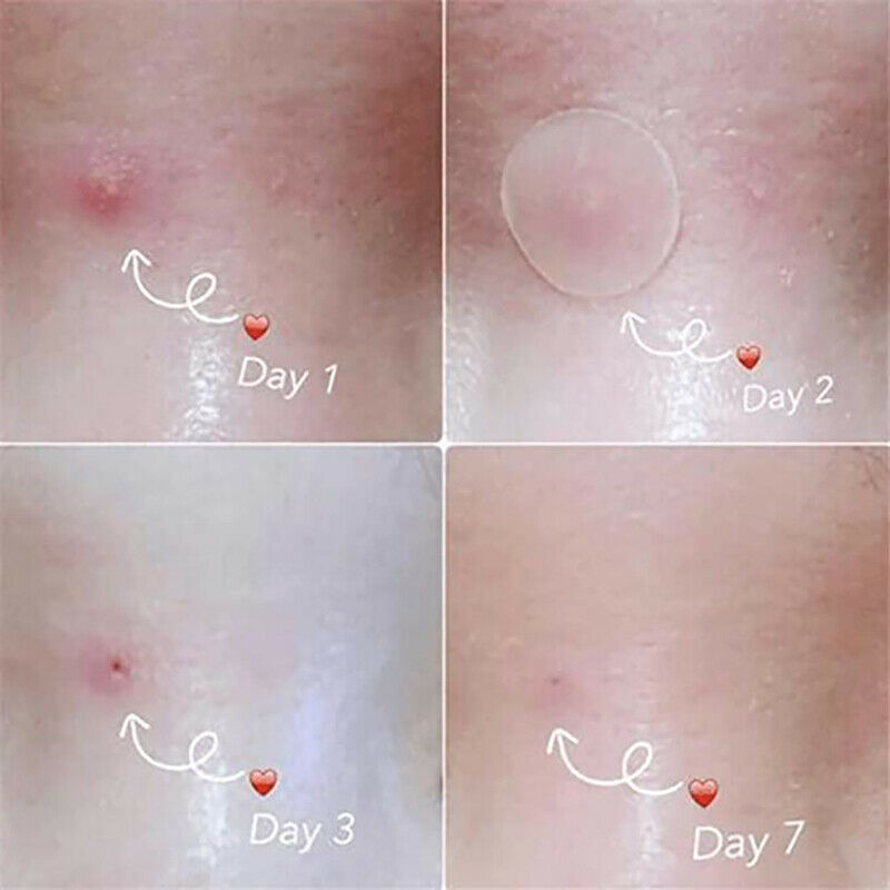 36Pcs Skin Tag & Acne Patch Hydrocolloid Acne and Skin Tag Remover Patch.l8