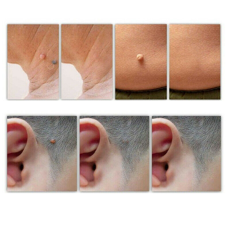 Skin Tag Remover Patch Ance Pimple Patch Anti-infection Quick Absorb Face.l8