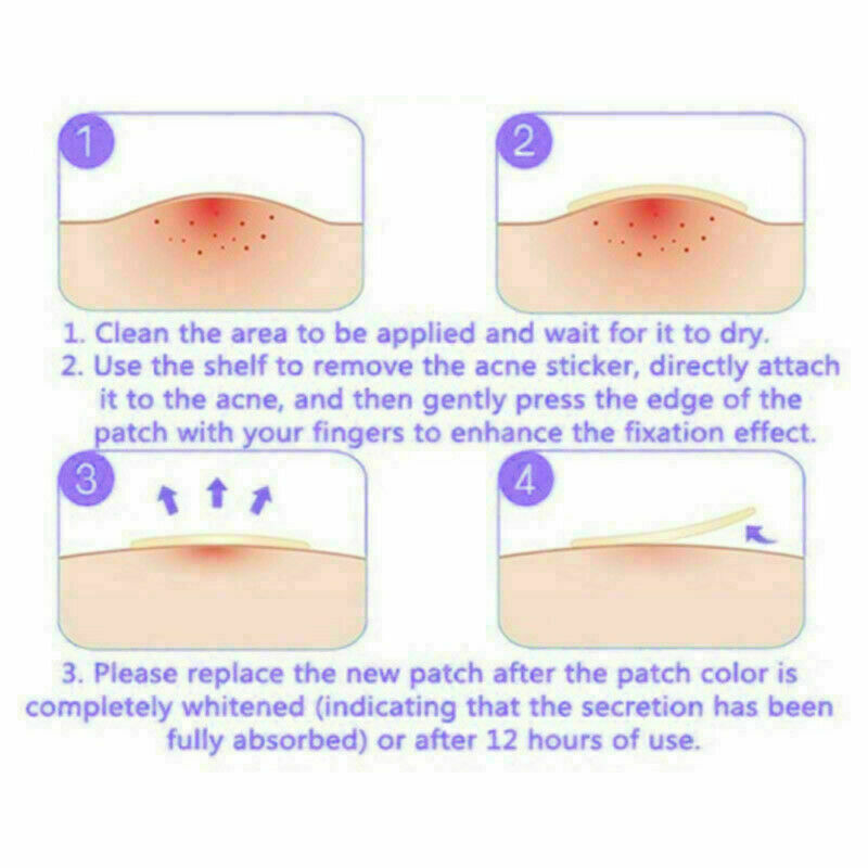 72Pcs Dermopatchy Acne & Skin Tags Pimple Remover Patch Removal Facial Care