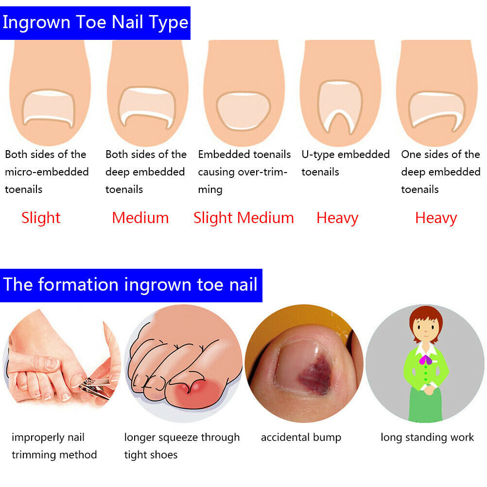 12pcs toenail correction tool ingrown wire fixer toe nail recover foot  TwY1