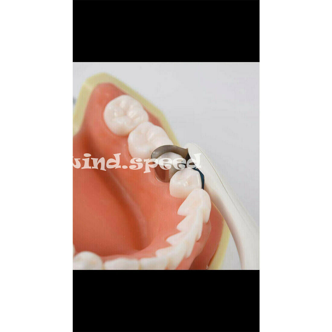 100pcs Dental PRO Matrix Bands Adjust Hold Single Use Curved Bands 6mm For Molar