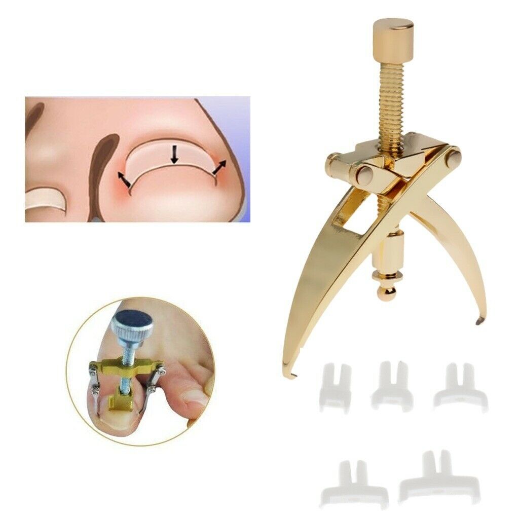 Ingrown Toenail Correction Braces Kit Professional