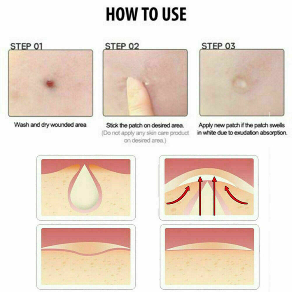 36Pcs Remover Patch Stickers Acne Set Pimple Master Treatment Skin Care Tools