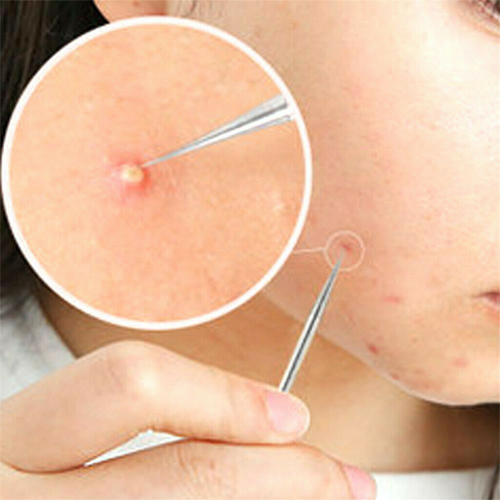 4 Piece Blackhead Acne Comedone Blemish Extractor Remover Stainless Tool Kit