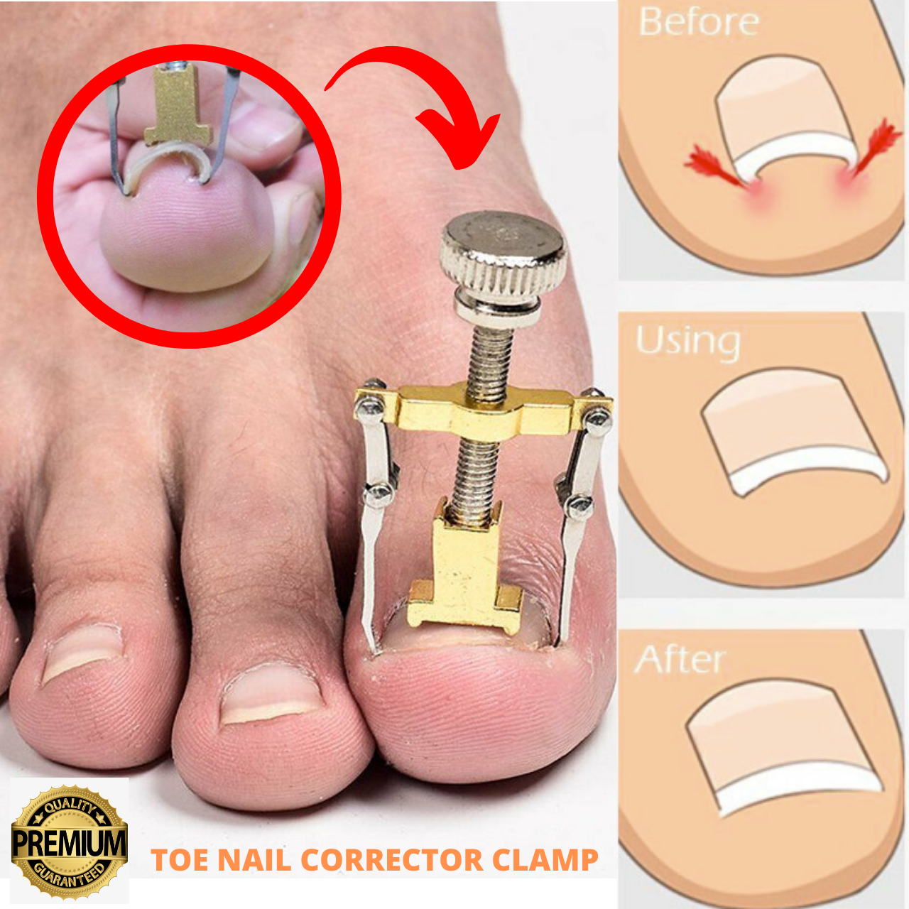 Ingrown Toe foot Nail Correction Fixer Nail Pedicure Tool Toenail Corrector US