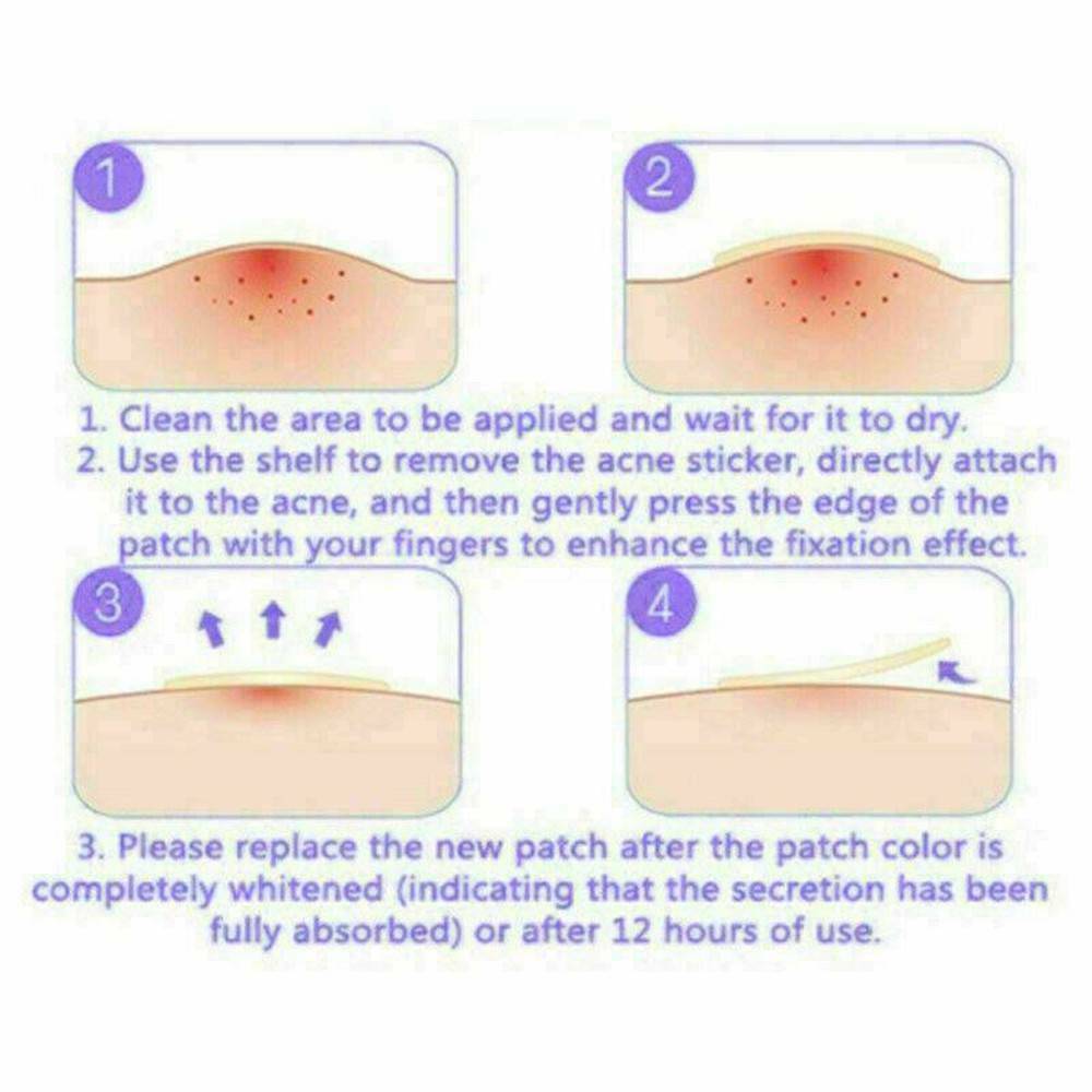 72PCS DERMOPATCHY ACNE SKIN TAGS PIMPLE REMOVER PATCH REMOVAL FACIAL CARE SPOT !